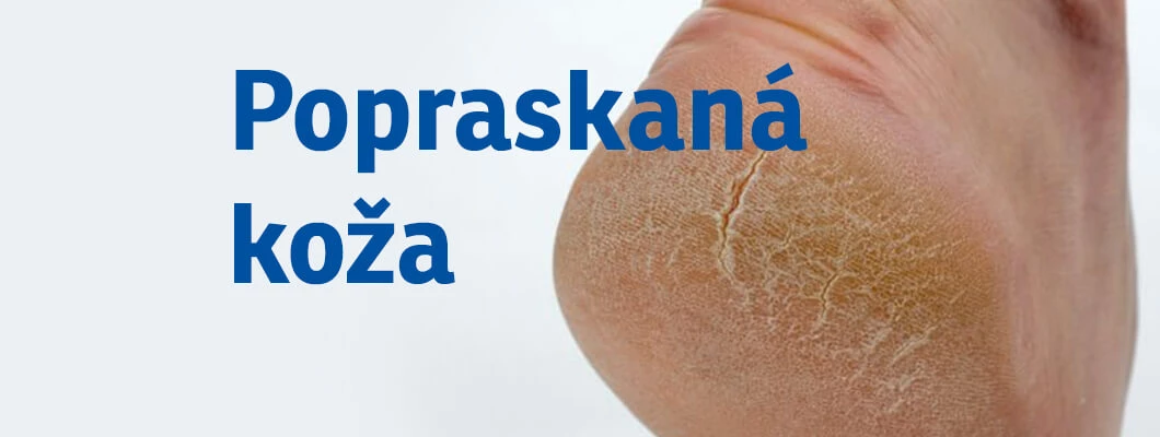 Popraskaná koža Popraskaná koža
